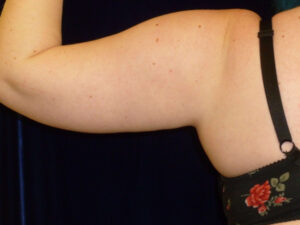 Liposuction patient