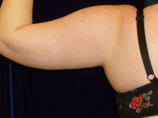 Liposuction patient