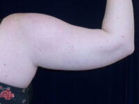 Liposuction patient