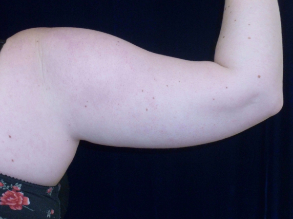 Liposuction patient