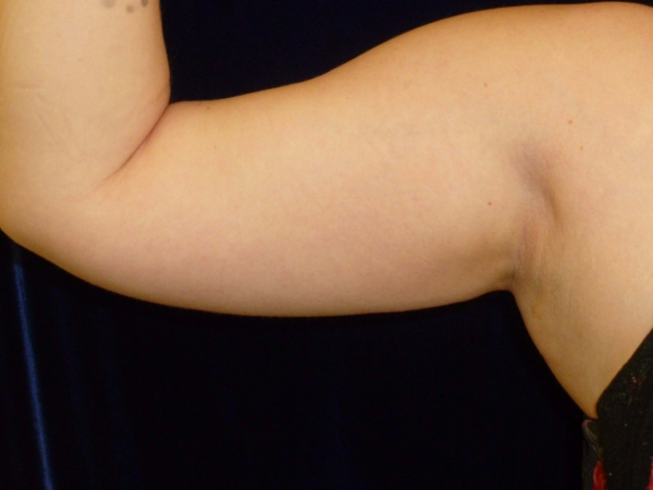 Liposuction patient