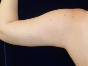Liposuction patient