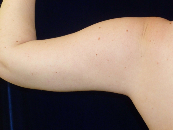 Liposuction patient