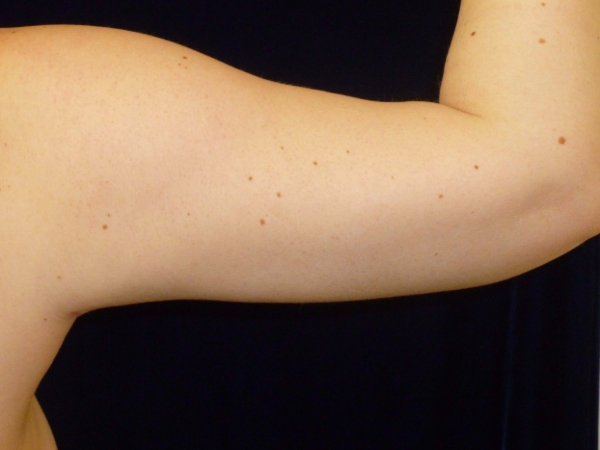 Liposuction patient