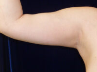 Liposuction patient