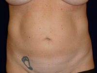 Liposuction patient