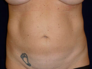 Liposuction patient