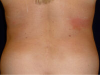 Liposuction patient