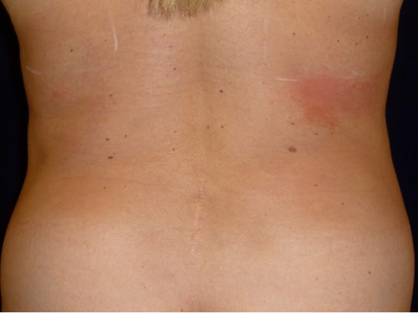 Liposuction patient