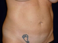 Liposuction patient