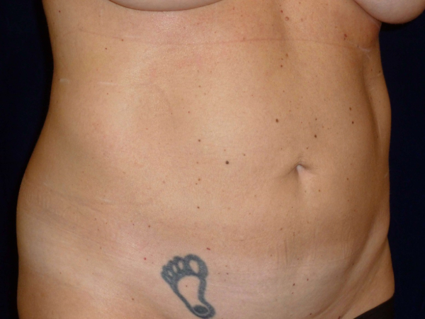 Liposuction patient