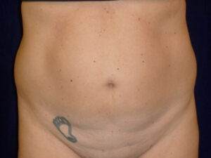 Liposuction patient