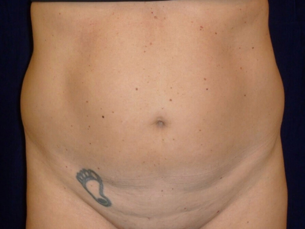 Liposuction patient