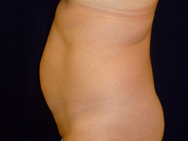 Liposuction patient