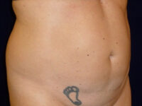 Liposuction patient