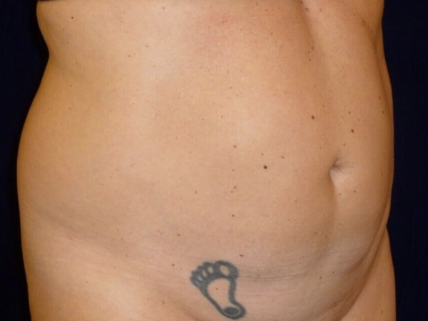 Liposuction patient