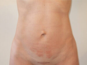 Liposuction patient
