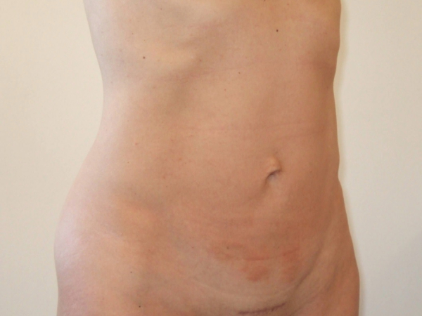 Liposuction patient