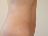 Liposuction patient