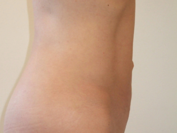 Liposuction patient