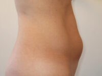 Liposuction patient