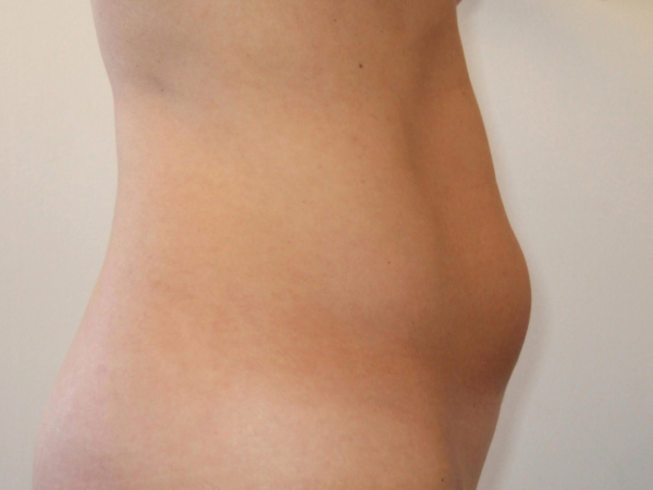 Liposuction patient