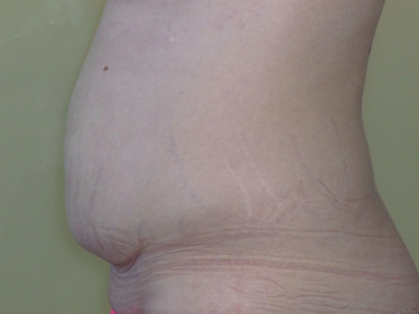 Liposuction patient