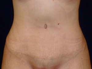 Liposuction patient