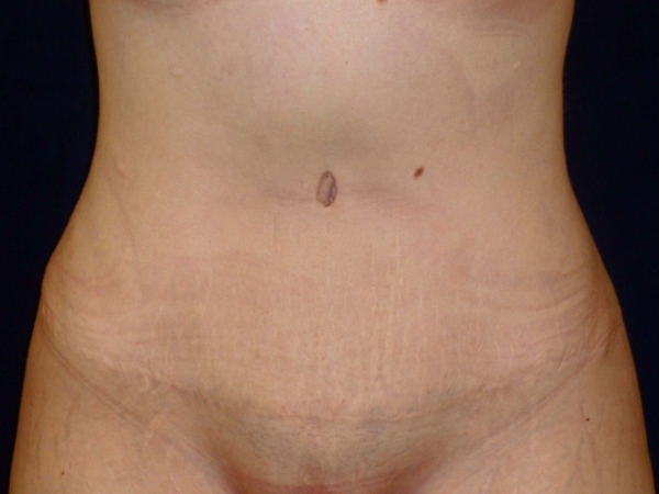 Liposuction patient