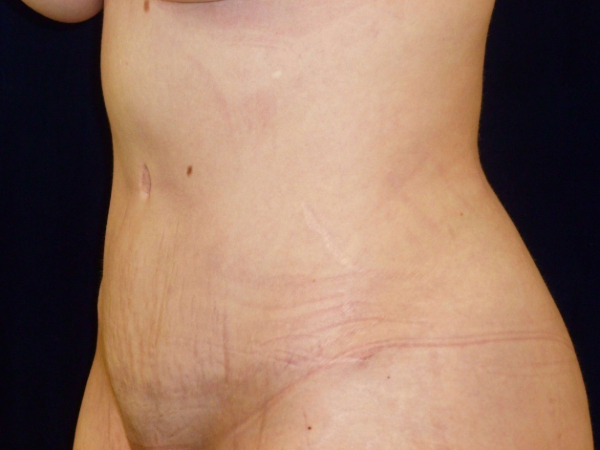 Liposuction patient