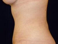 Liposuction patient