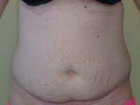 Liposuction patient