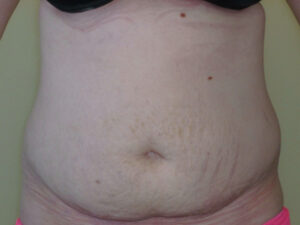 Liposuction patient
