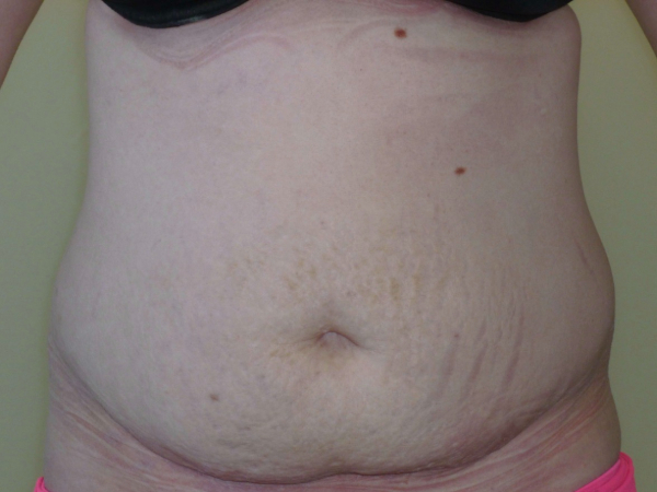 Liposuction patient