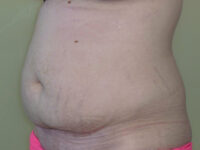 Liposuction patient