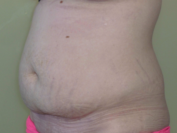 Liposuction patient