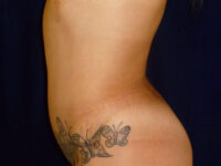 Liposuction patient
