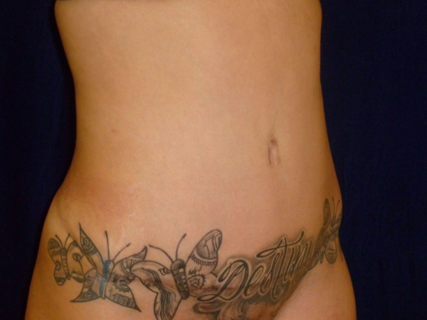 Liposuction patient