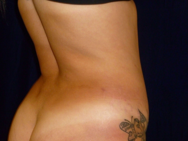 Liposuction patient