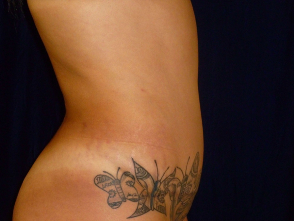 Liposuction patient