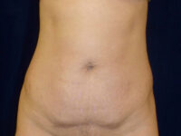 Liposuction patient