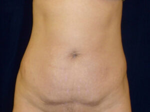 Liposuction patient
