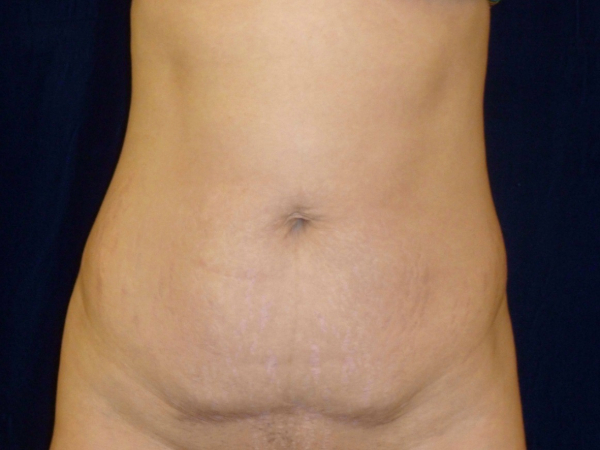 Liposuction patient