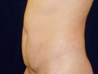 Liposuction patient