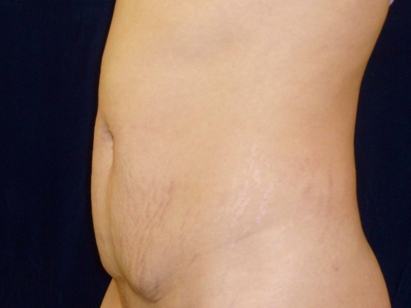 Liposuction patient