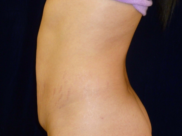 Liposuction patient