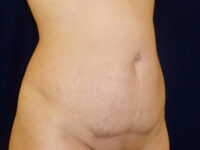 Liposuction patient