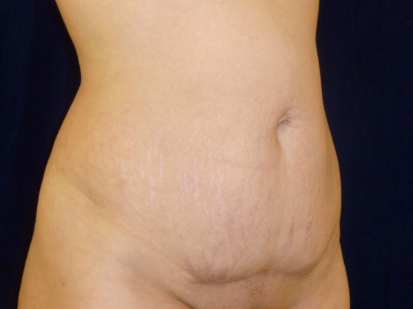 Liposuction patient