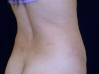 Liposuction patient