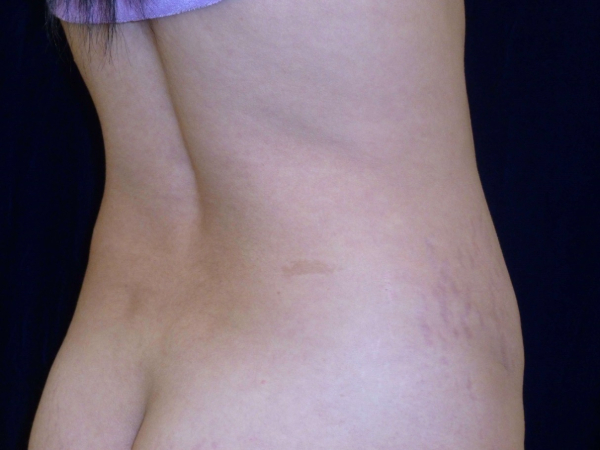 Liposuction patient